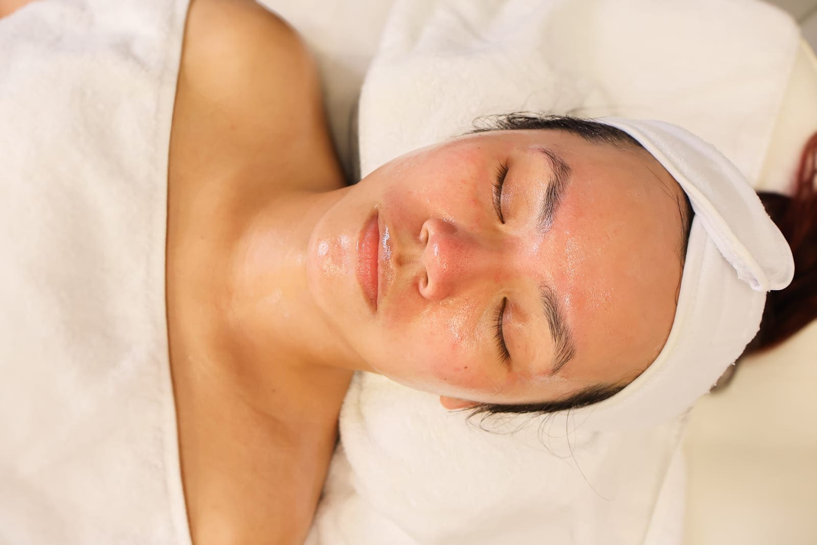 Chemical Peels
